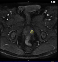 MRT_prostata_DCE_2