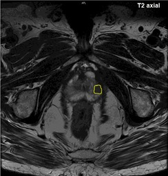 MRT_prostata_T2_2